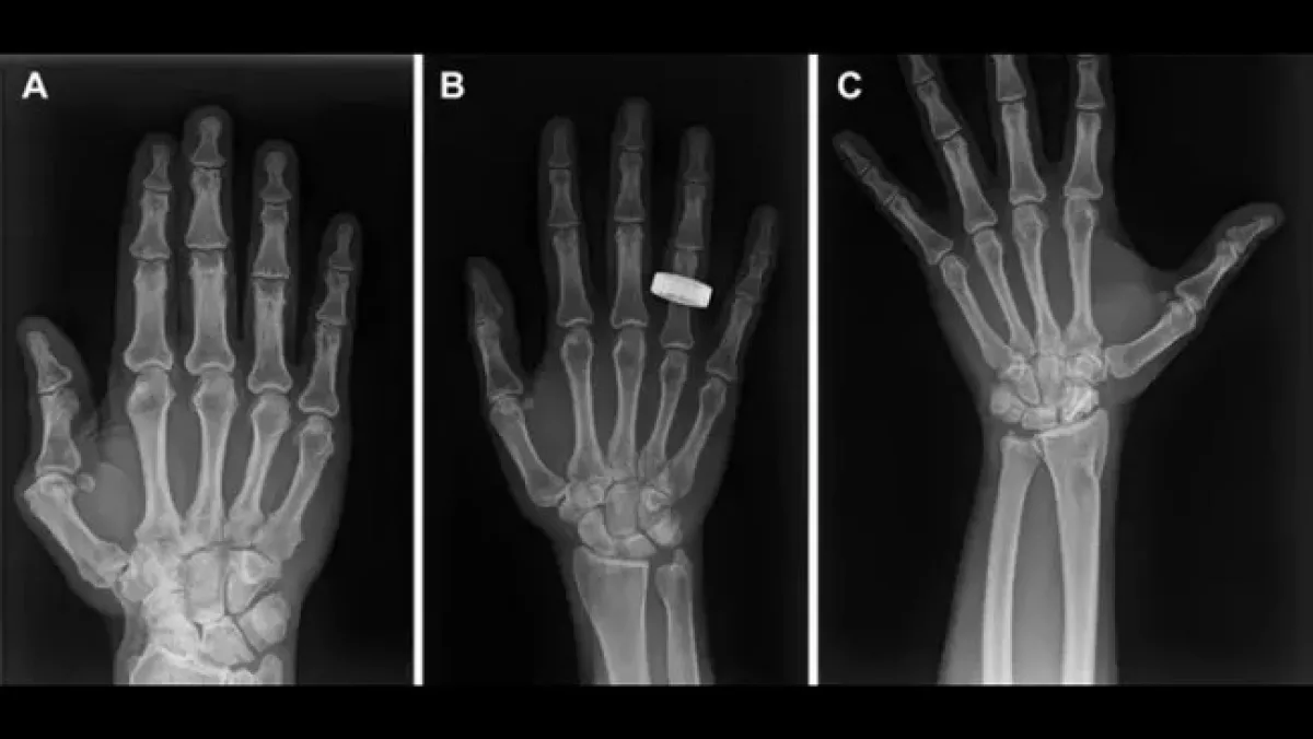 The left image shows an X-ray of a crew member's hand before the trip. The center picture was taken while they were in space, and the one on the right shows their hand after returning home. (Image credit: RSNA)